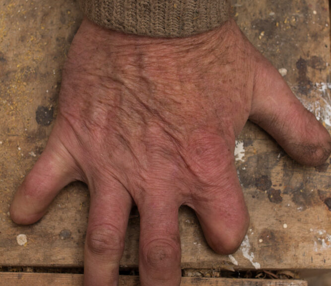 A man showcases his hand absent one finger--just one of many funeral customs from around the world designed to show reverence for the dead.